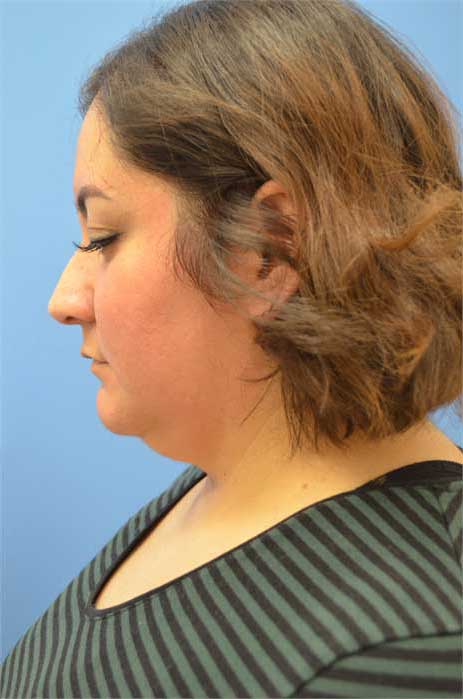 Chin Liposuction Before & After Image