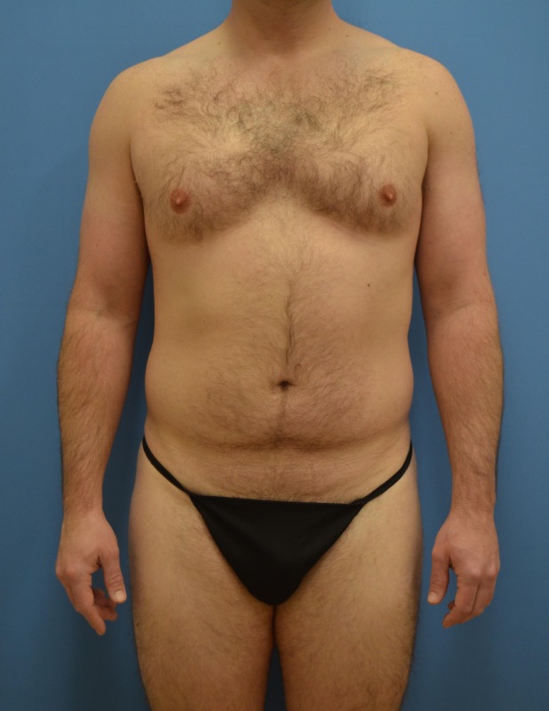 Muscle Makeover Before & After Image