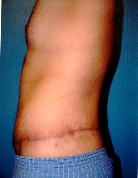 Male Torsoplasty Before & After Image